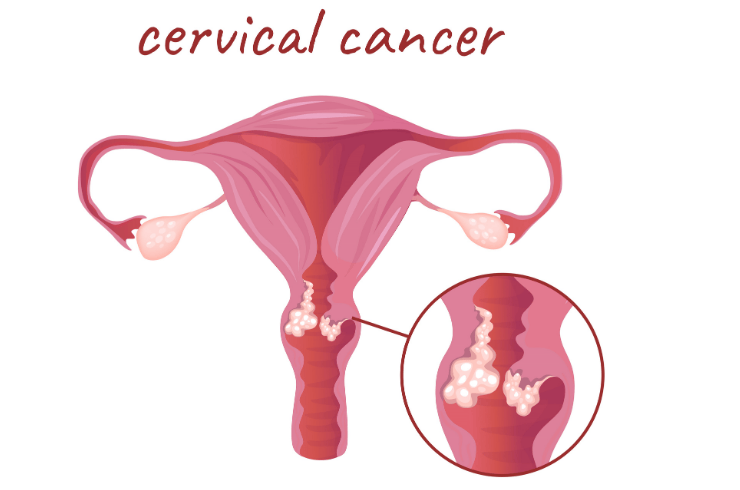 Gynae Cancer Surgery
